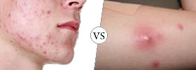 Acne vs Boils