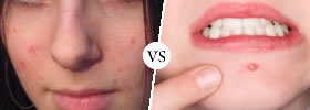 Acne vs Pimples