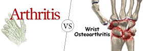  Arthritis vs Osteoarthritis