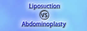 Liposuction vs Abdominoplasty