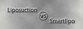 Liposuction vs Smartlipo