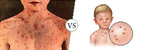 Measles vs Chickenpox