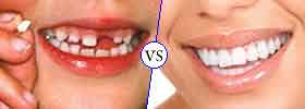 Primary Teeth vs Permanent Teeth