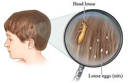 Difference between Nits and Lice | Nits vs Lice
