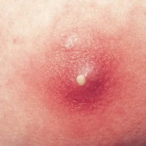 hpv warts popping
