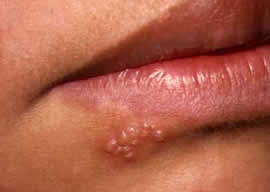 Mouth warts causes. Mouth warts remedy.