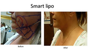 How does Smart Lipo surgery differ from regular liposuction?
