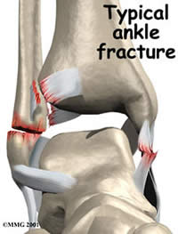 Difference between Ankle Sprain and Fracture | Ankle Sprain vs Fracture