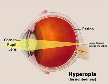 hyperopia és myopia plusz és mínusz