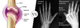 Arthritis vs Rheumatoid Arthritis