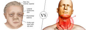 Cretinism vs Hypothyroidism