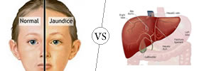 Jaundice vs Hepatitis