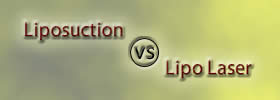 Liposuction vs Lipo Laser