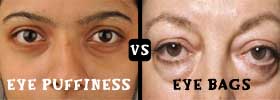Eye Puffiness vs Eye Bags