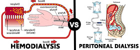  Hemodialysis vs Peritoneal Dialysis
