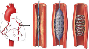 Difference between Angioplasty and Angiography 