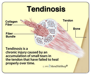Tendinosis